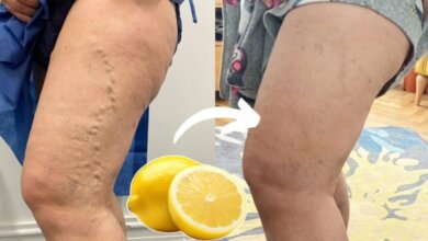 Lemon for Varicose Veins A Simple Natural Remedy