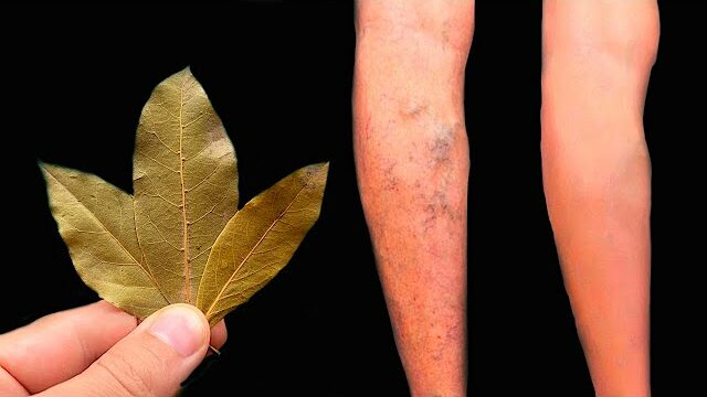 Unbelievable Get Rid of Varicose Veins with Bay Leaf This Treasure Should Be in Every Home